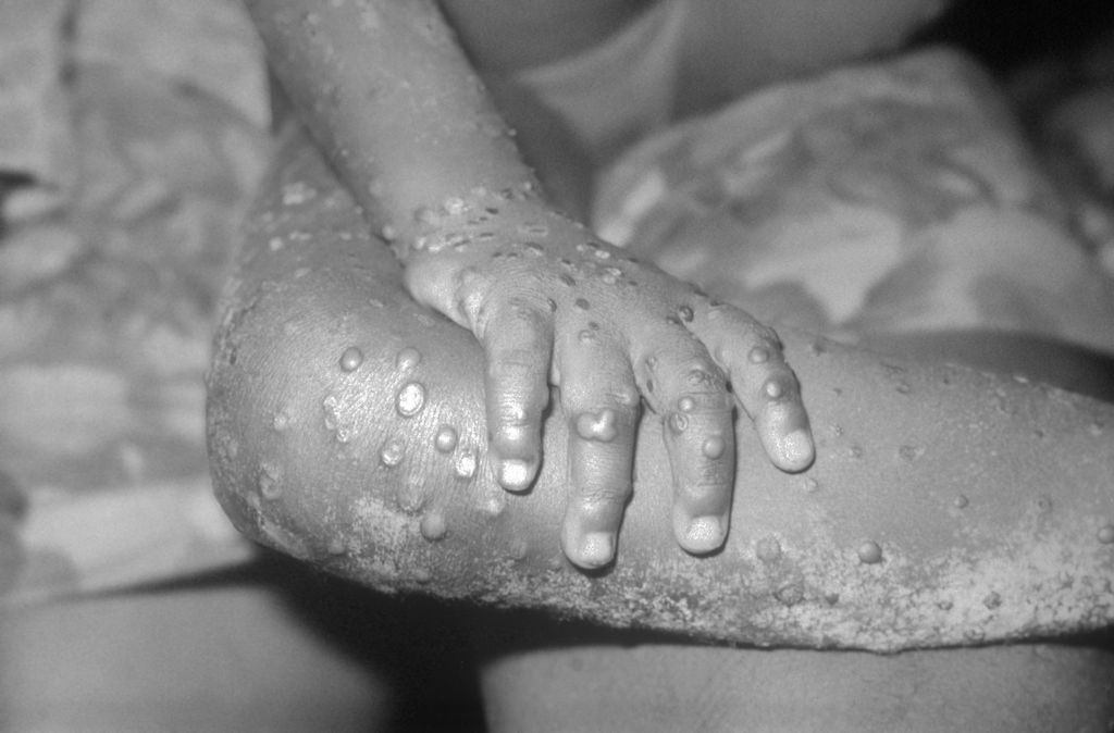 Kne og arm med mange blemmer hos et barn. Foto.