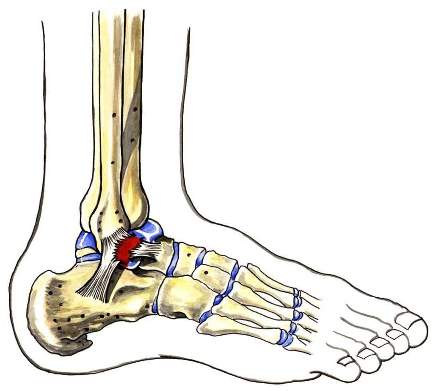 Avslite leddband på utsida av ei okle markert i raudt. Illustrasjon.