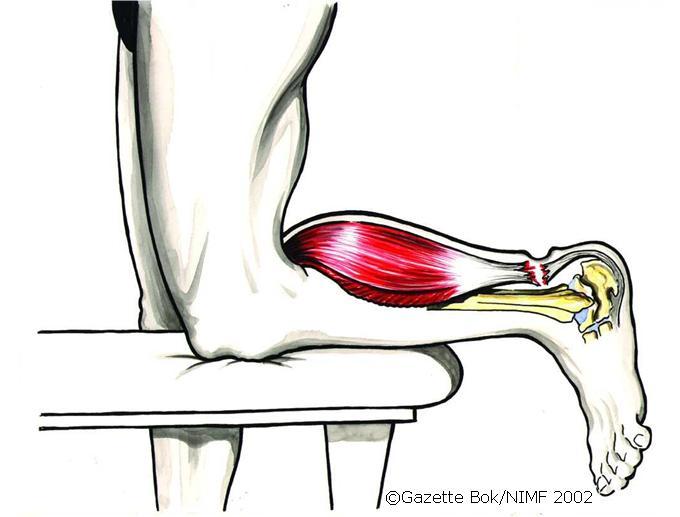 Illustrasjon av en fot med ei akillessene som er slitt av.