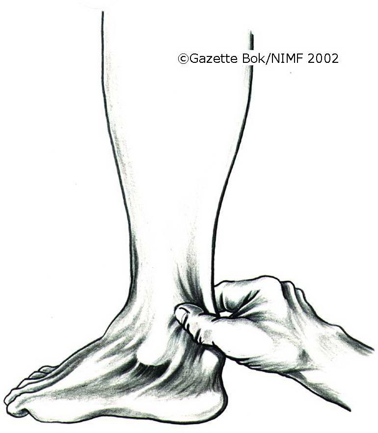 To fingre klemmer rundt en akilles. Illustrasjon.