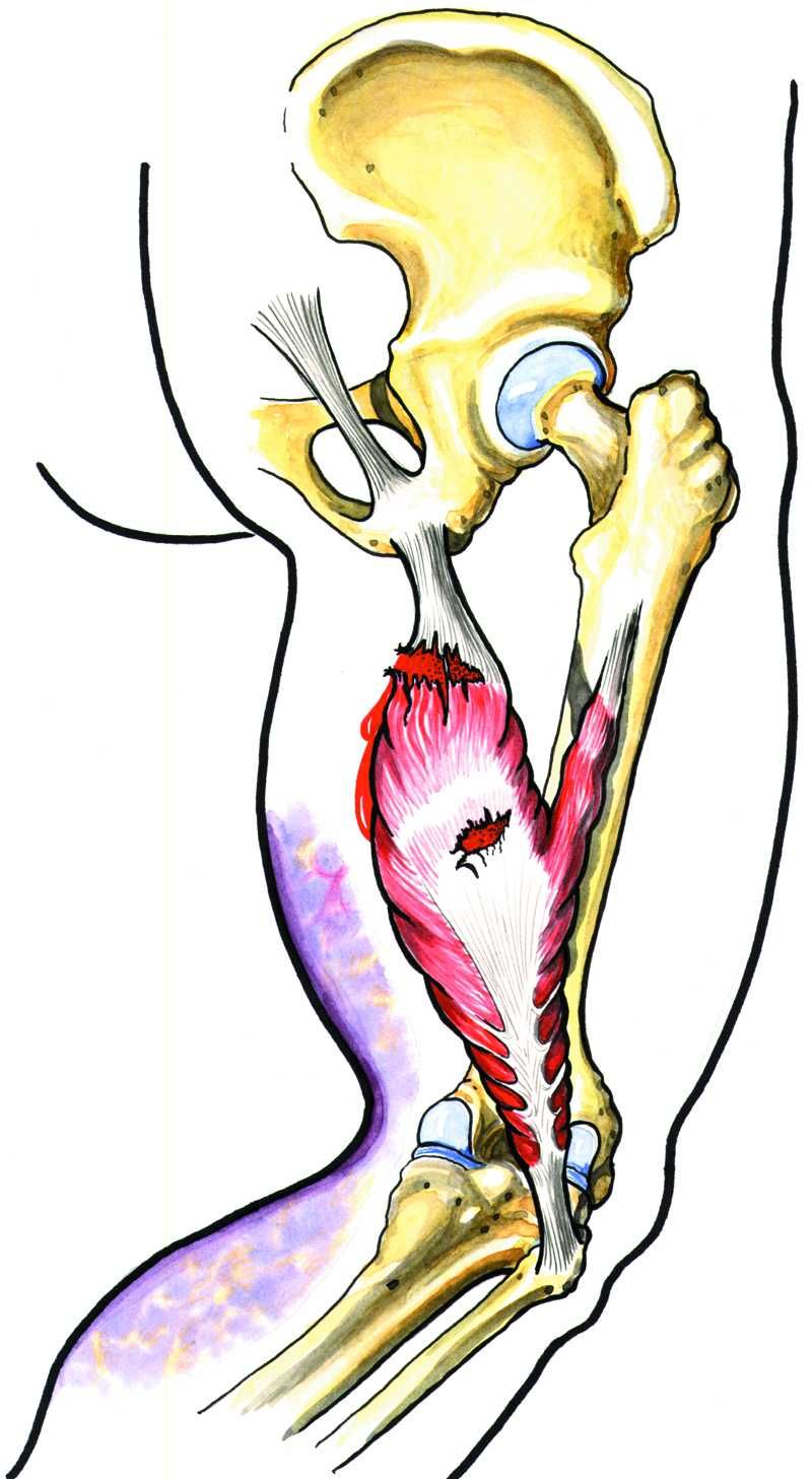 Illustrasjon av skjelett og en lårmuskel med strekk i hamstring.