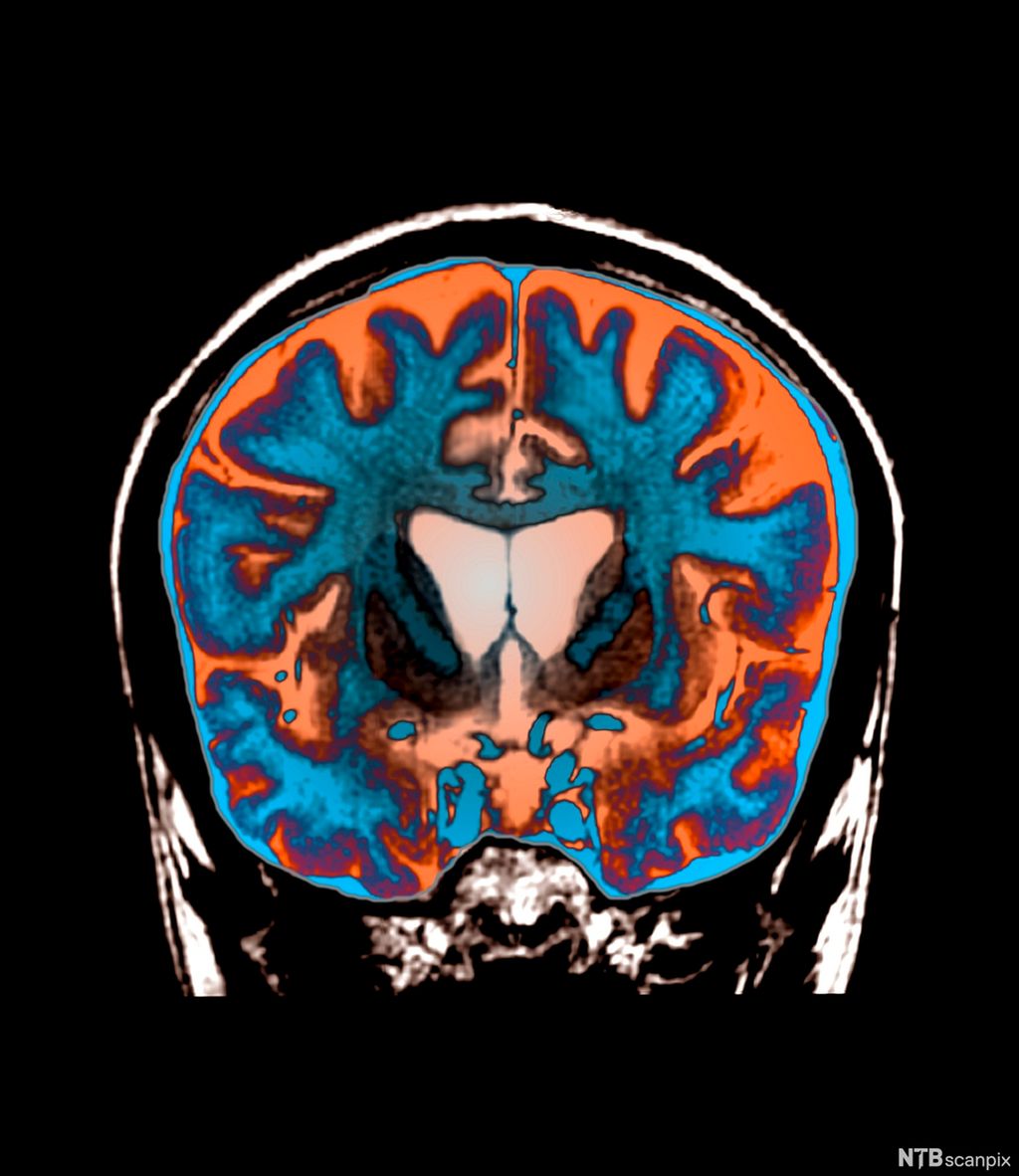 Huntingtona dávda, MR govva vuoiŋŋamaččain.Govva.