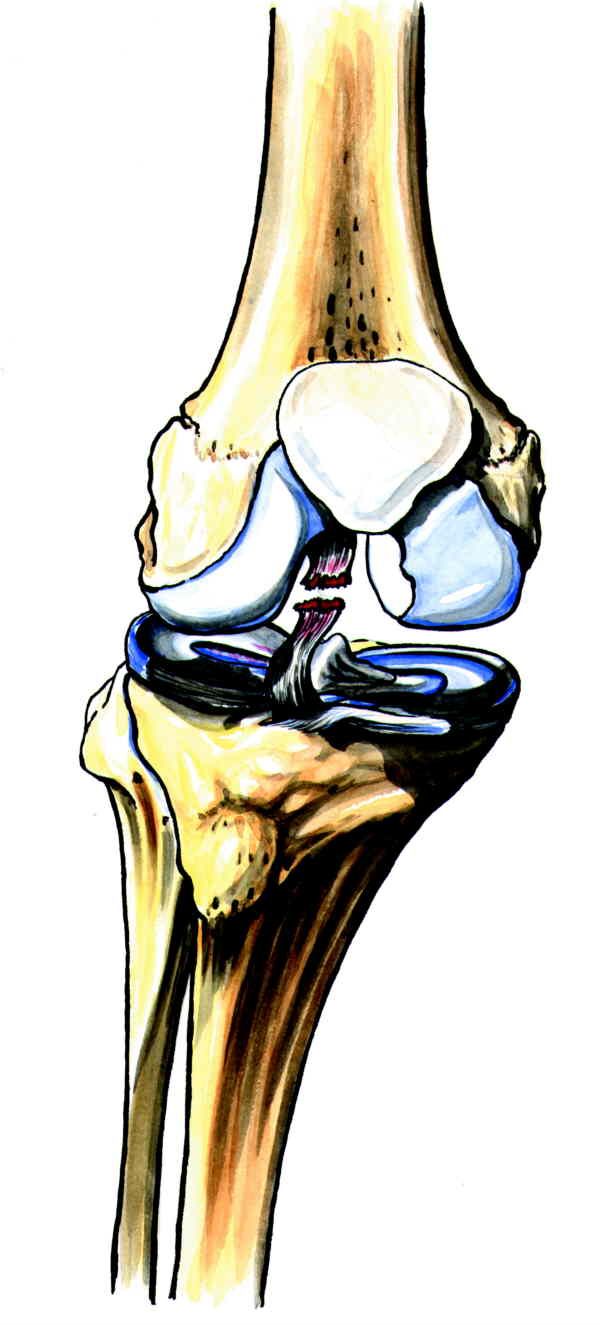 Avrive korsband i kne. Illustrasjon.