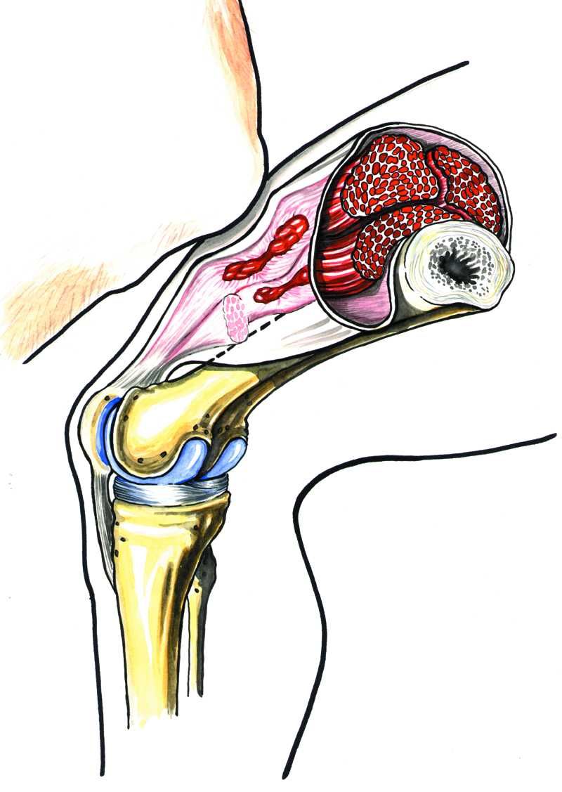 Et kne treffer en annens lår, som fører til lårhøne. Illustrasjon.