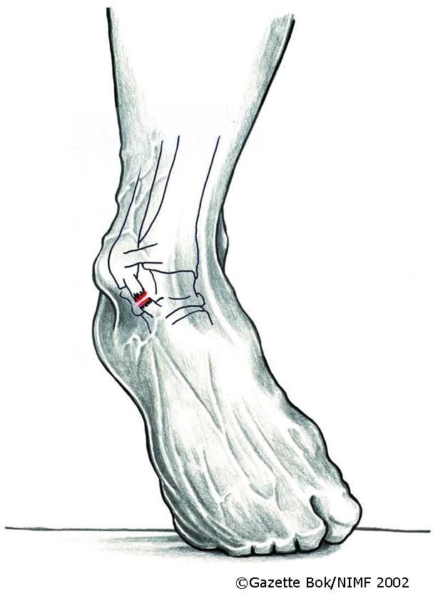 Ankelskade på utsida av ei okle, markert i raudt. Illustrasjon.
