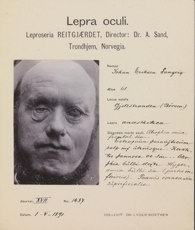 En legejournal på en leprapasient ved Reitgjerdet i Trondheim. Det er fylt inn informasjon og diagnose for hånd. Det er også et bilde av den syke, som blant annet har dårlige øyne. Foto. 