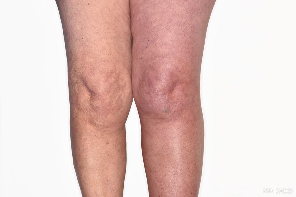 Bilde av to bein. Det venstre er rødere enn det høyre. Foto.