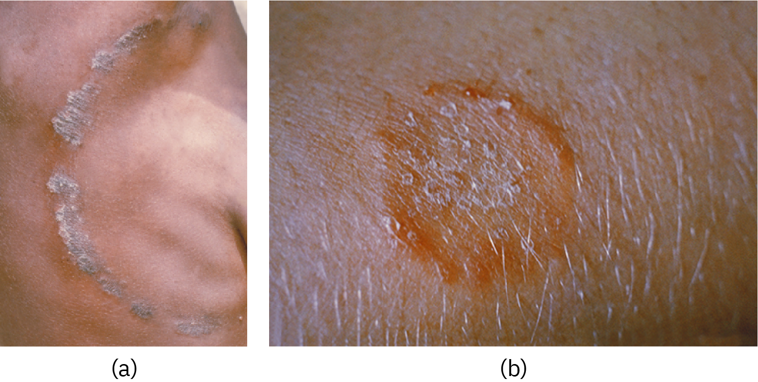  Nærbilde av hud med ringformet utslett. Foto.