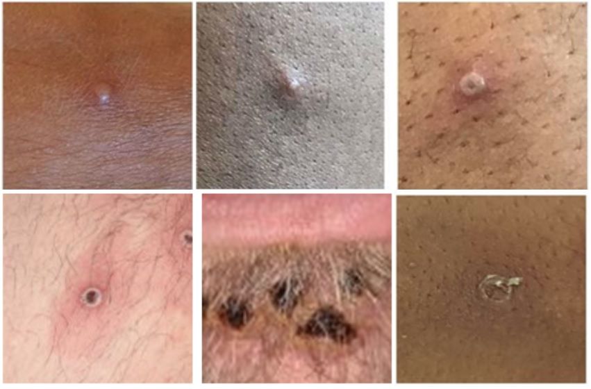 Seks bilder av hud med blemmer, sår og arr som utslett fra apekopper. Foto.