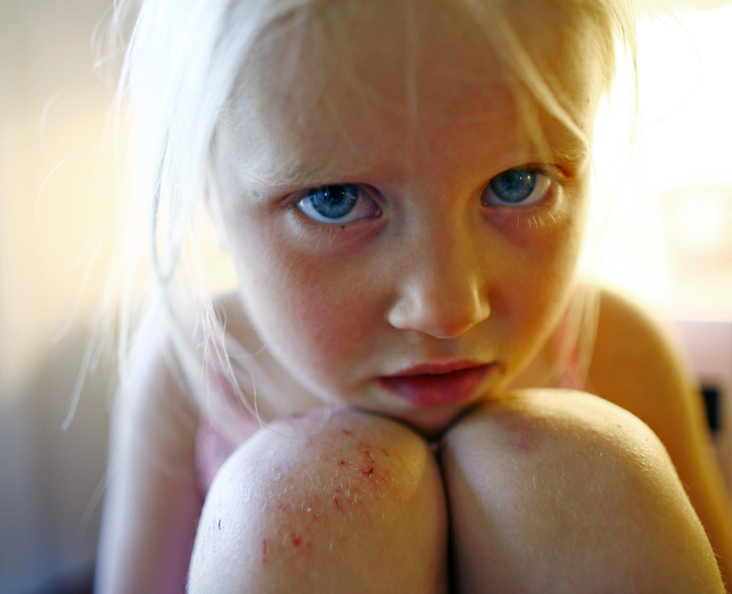 Liten jente med skrubbsår på knærne. Foto.