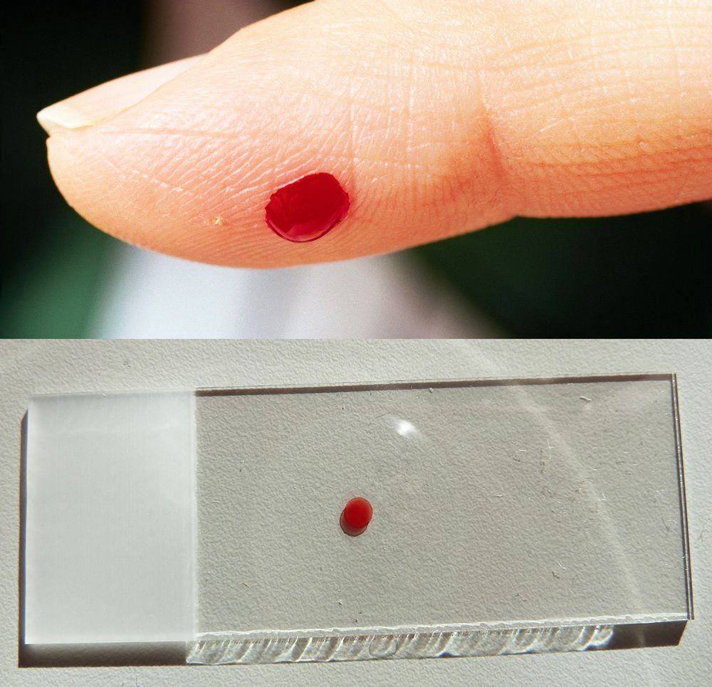 En finger med bloddråpe over et objektglass. Foto.