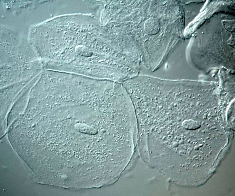 Fargeløse runde celler med tydelig kjerne og kornete cytoplasma. Foto.