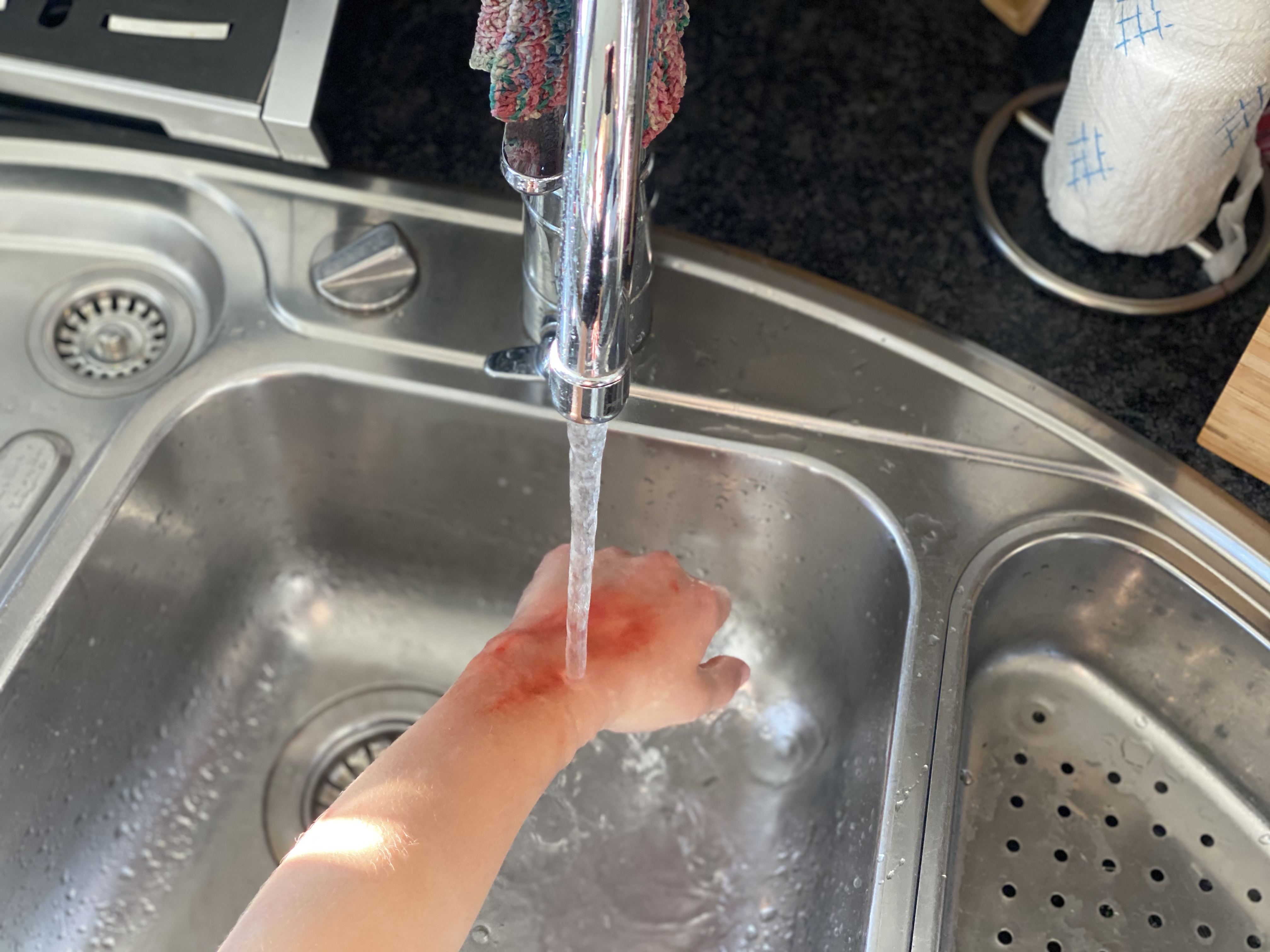 Hånd med forbrenningsskade holdes under rennende vann. Foto. 