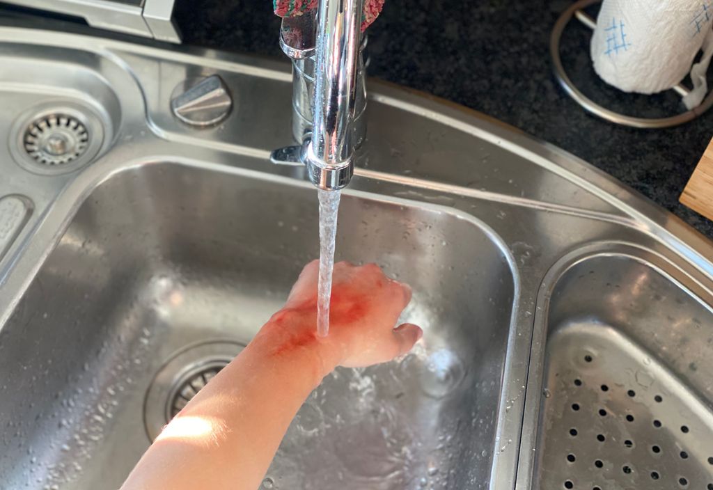 Hånd med forbrenningsskade holdes under rennende vann. Foto.