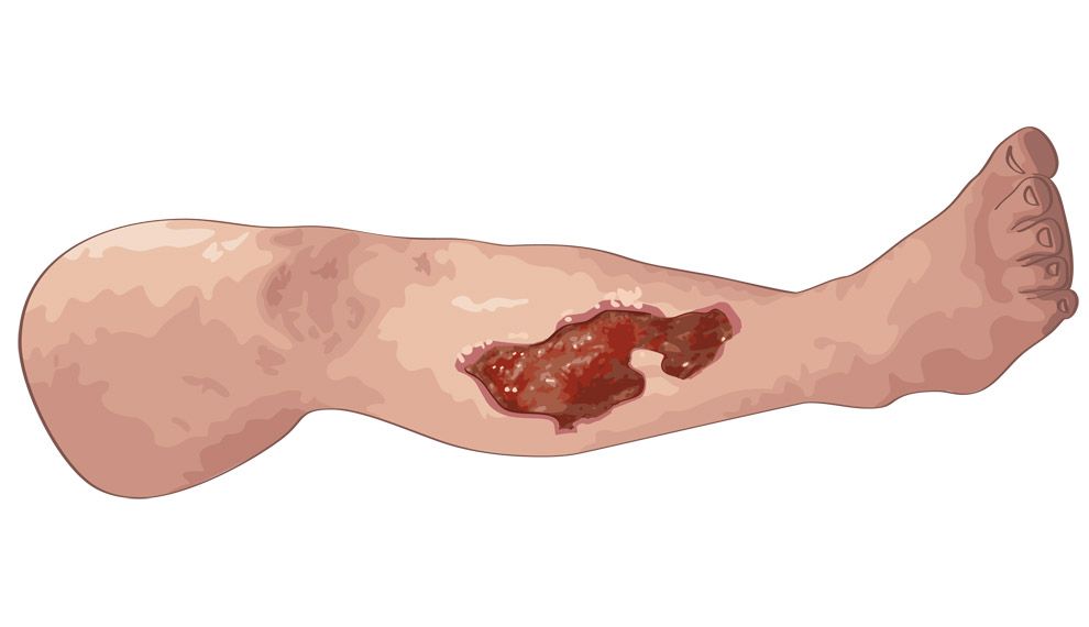 Tegning av et bein med leggsår. Illustrasjon.