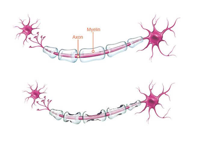 Illustrasjon av en frisk og en skadet nervecelle
