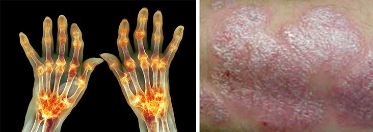 Røntgenbilde av krokete fingre og foto av hud med flassende utslett. To foto.