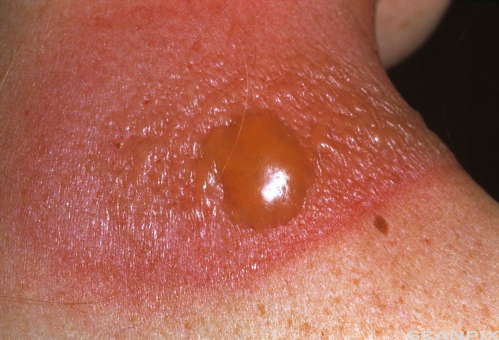 Brannskadet hud med blemme. Foto. 