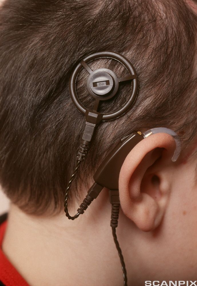 Cochlea implantat. Foto.