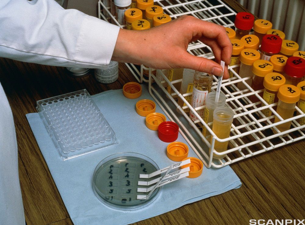 Brett med mange urinprøver, noen uten lokk. Ei hånd stikker en strimmel i det ene åpne glasset. Foto.