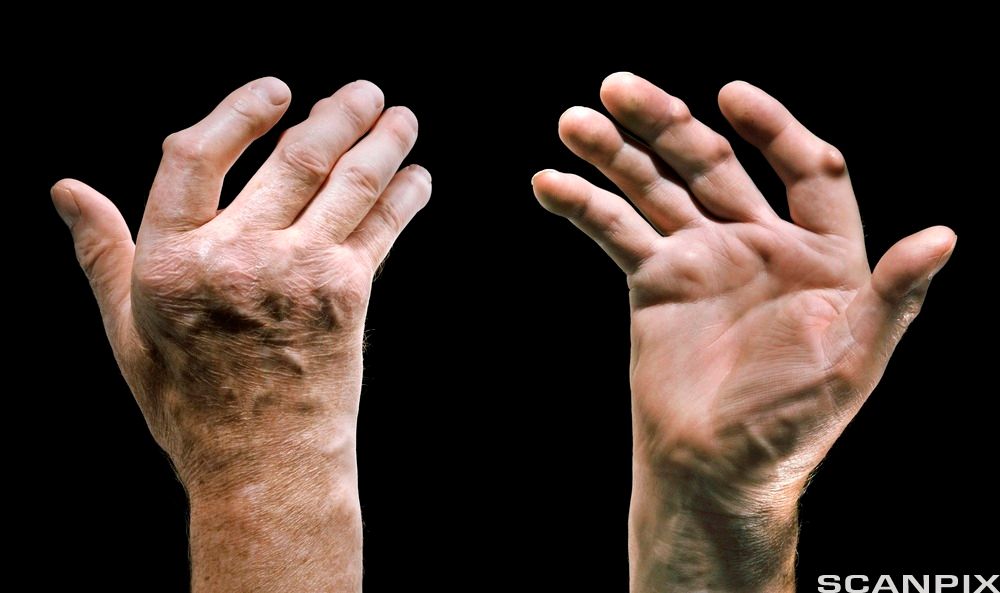 Ei hånd med fingerleddsartrose sett fra begge sider. Det er knuter på fingerleddene. Foto.