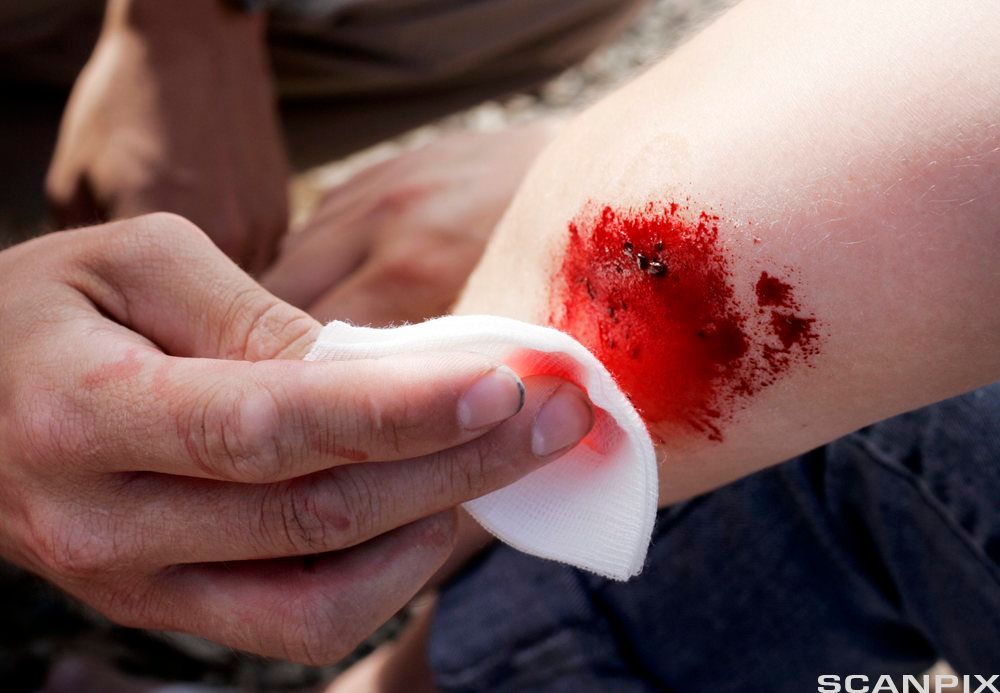 Sår på albue blir rengjort med kompress. Foto.