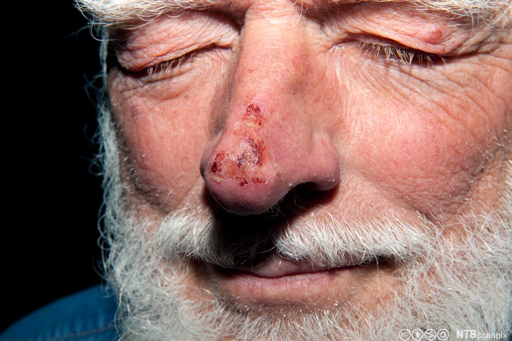 Nese med frostskade. Foto.