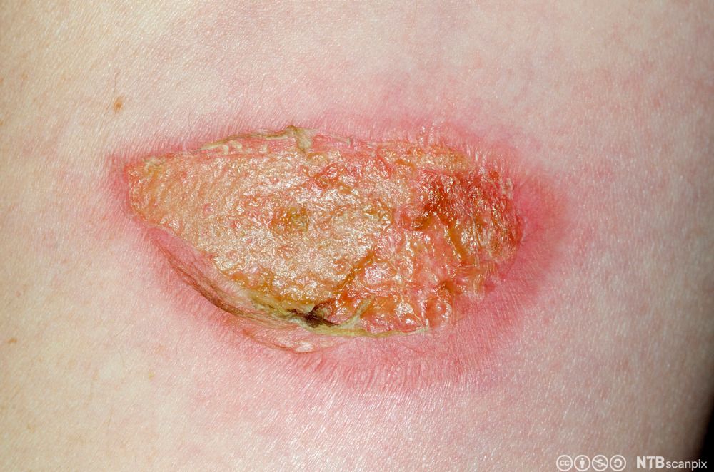 Et sår med gulgrønn verk og rødfarget hud rundt. Illustrasjon.