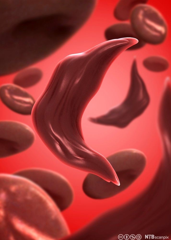 Røde blodceller der mange er sigdformet. Illustrasjon.