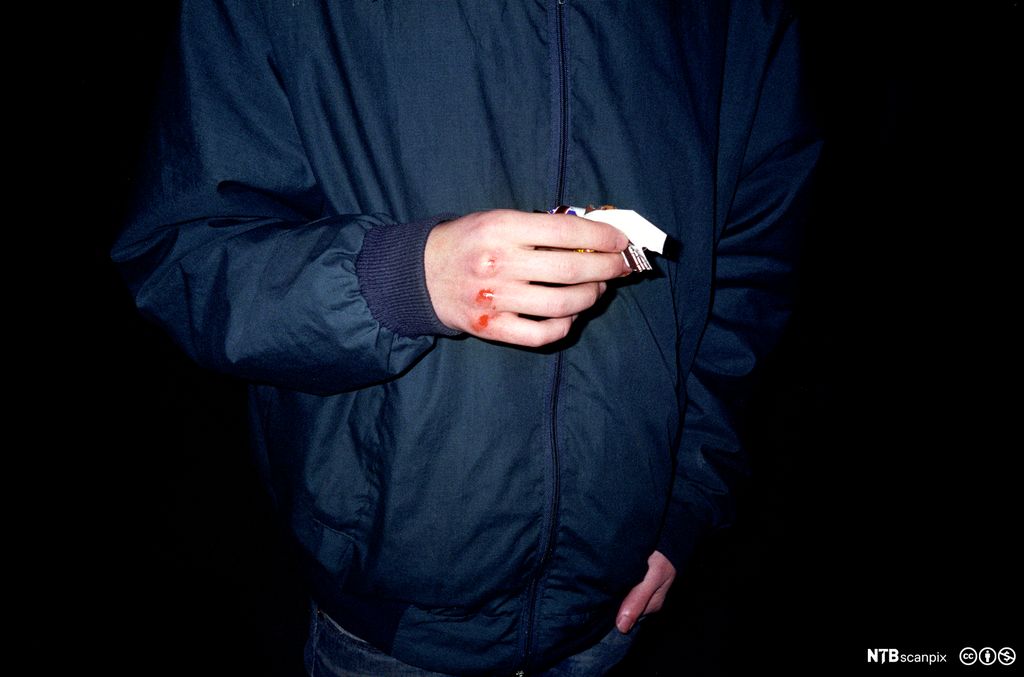 Ein person i mørkeblå jakke har blodige knokar. Det er berre overkroppen til personen som visast på biletet. Foto. 